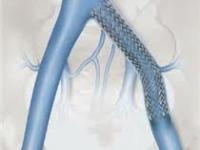 Zilva Venous Self Expanding Stent